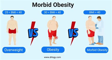 obease|Obesity: What It Is, Classes, Symptoms, Causes